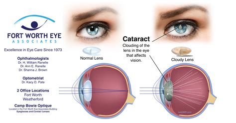 cataract surgery in huddersfield|Cataract Surgery .